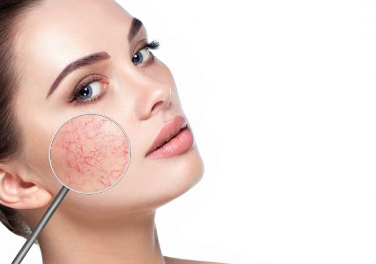 How to take care of the capillary skin?