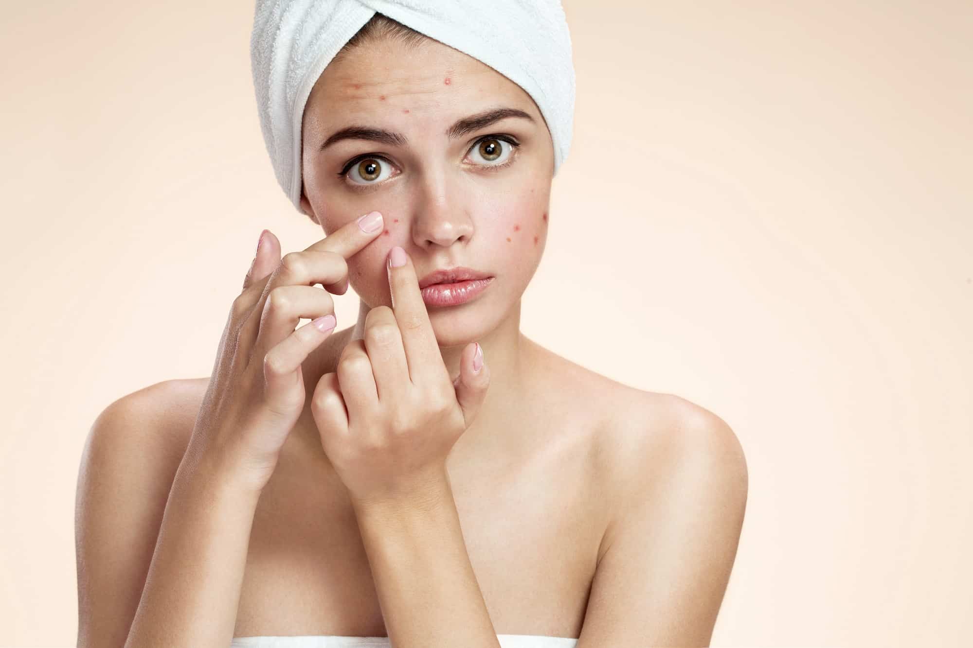Adult acne – we suggest what lifebloods to use to enjoy a smooth complexion