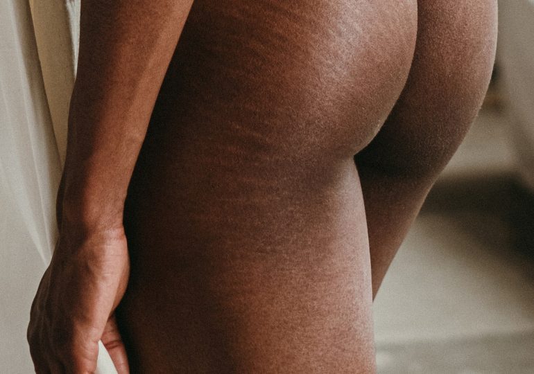 Stretch marks - how to fight them?