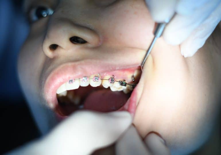 How should braces be taken care of?
