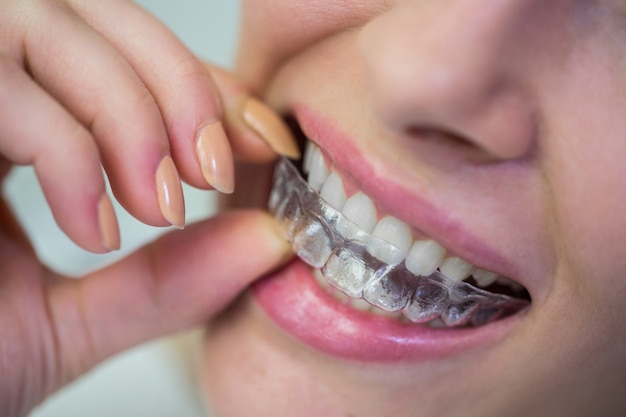 How Can Invisalign Transform Your Smile?